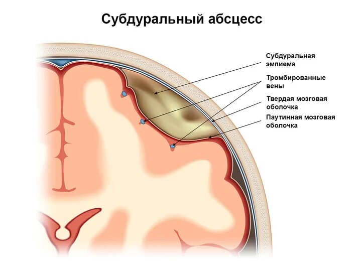 Субдуральный абсцесс кт. Внутричерепные осложнения фронтита. Субдуральный абсцесс мозга. Внутричерепные осложнения синусита. Субдуральная гематома лечение