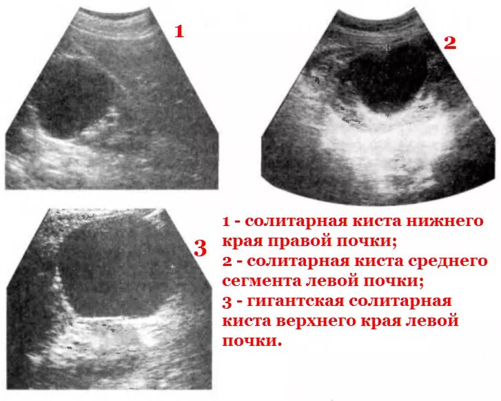 Кисты печени и почек. Солитарная киста почки УЗИ. Киста паренхимы почки УЗИ. Киста почки сонограмма. Кистозные образования в почке УЗИ.