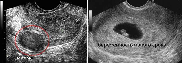 Можно забеременеть с полипом в матке. Миома и беременность на УЗИ.