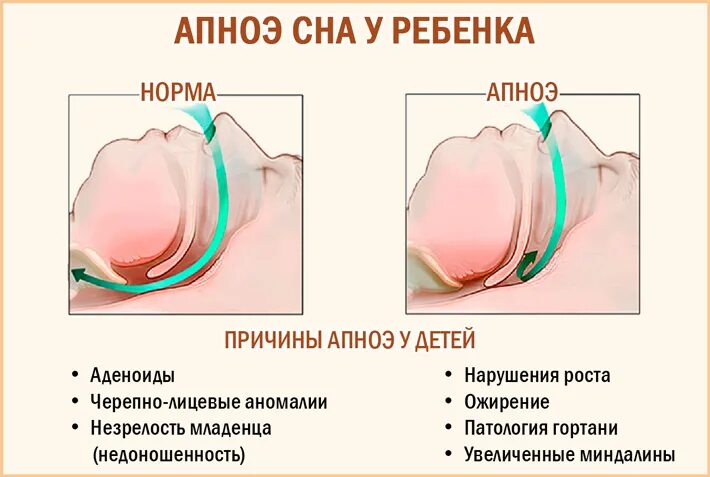 Дыхание в 6 месяцев. Признаки остановки дыхания у детей. Остановка дыхания во сне у грудничка. Апноэ у недоношенных новорожденных. Причины остановки дыхания у детей.