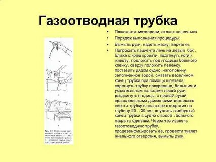Постановка газоотводной трубки сестринское дело