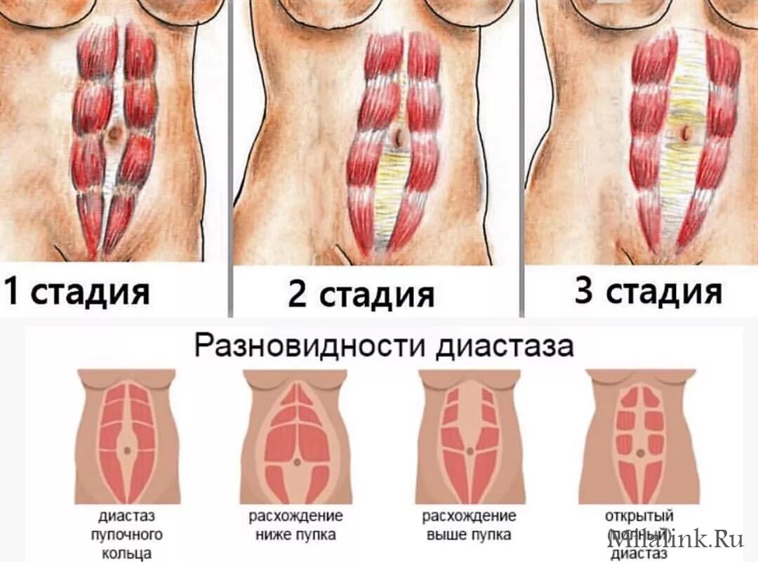 Прямая мышца живота у женщин. Диастаз мышц живота 2 степени. Диастаз мышц белой линии живота. Диастаз живота 1 степень.