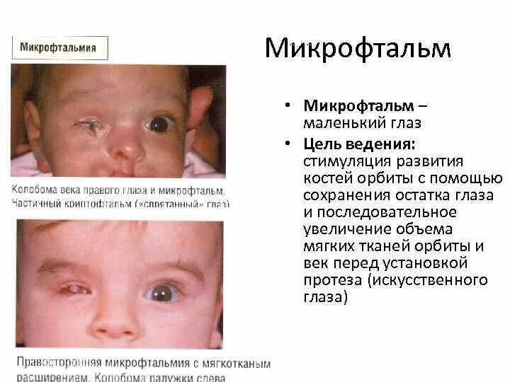 Анофтальм