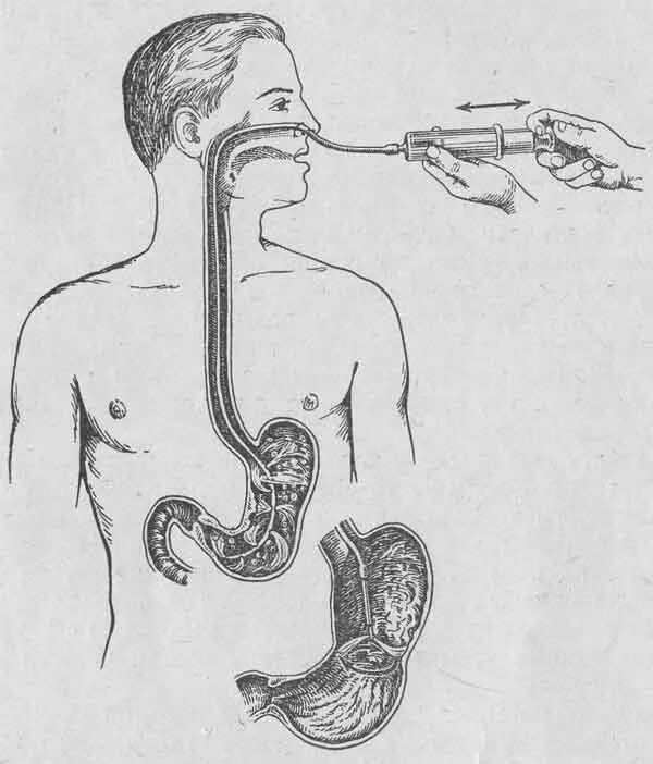 Желудочный зонд назогастральный. Назогастральный зонд промывание желудка. Дуоденальное зондирование трубка. Назогастральный зонд Введение. Надо пищевода