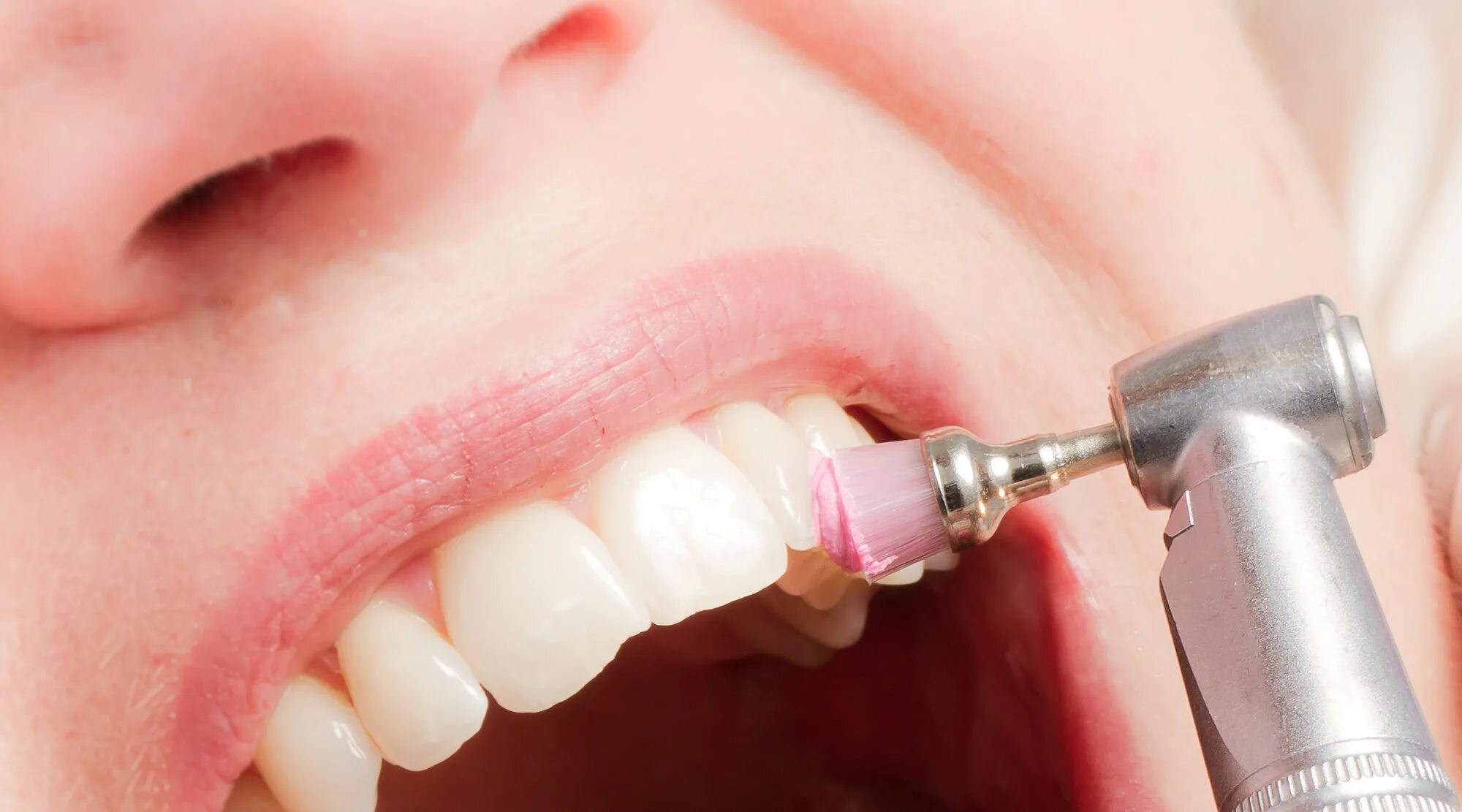 Профессиональная гигиена полости рта. Профгигиена ультразвуком. Удалить зуб в абакане. Удалить зуб в абакане. Поддесневые отложения зубной камень.