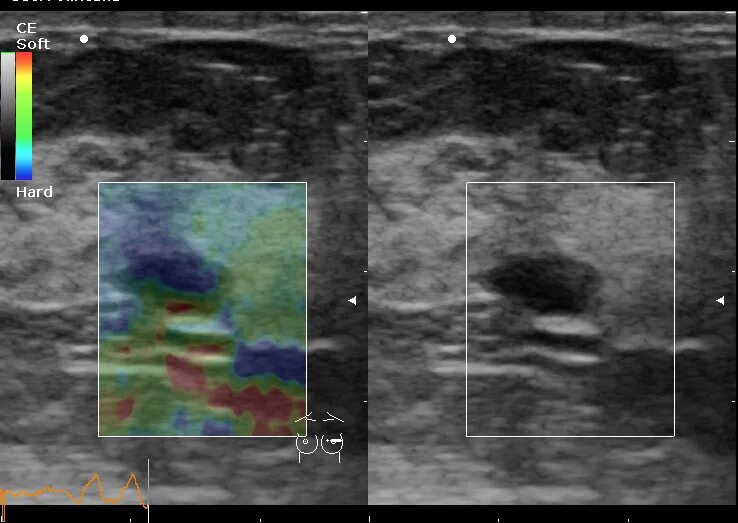 Эластография щитовидной железы что это. УЗИ молочных желез эластография. Соноэластография щитовидной железы. Эластография образований молочной железы. Соноэластография молочных желез.