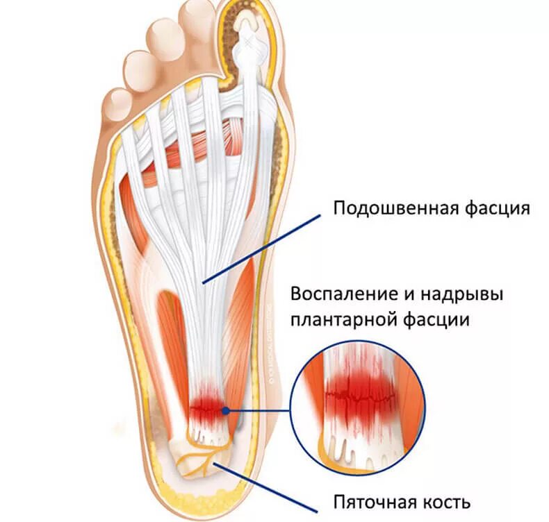 Пяточный фасцит
