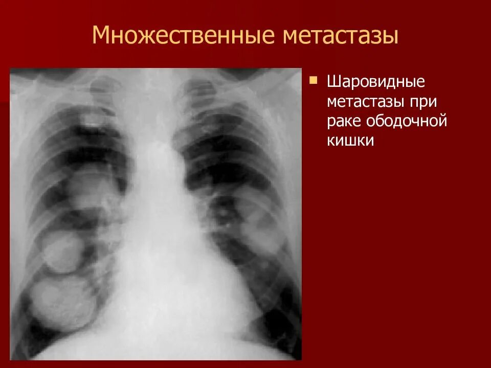 Какой рак метастазирует. Шаровидные метастазы в легких. Метастазы это простыми словами.