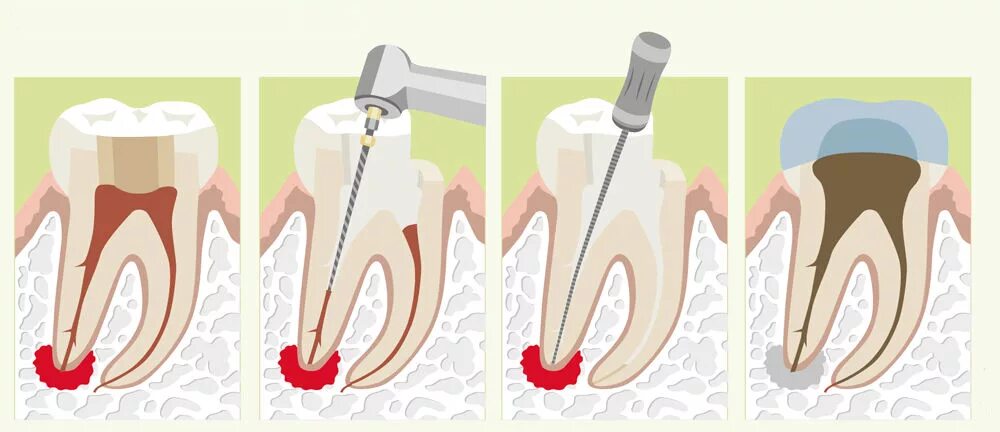 Временное лечение каналов зуба. Пульпит воспаление надкостницы. Гнойный периодонтит 36.