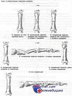 Проксимальная фаланга пальца перелом
