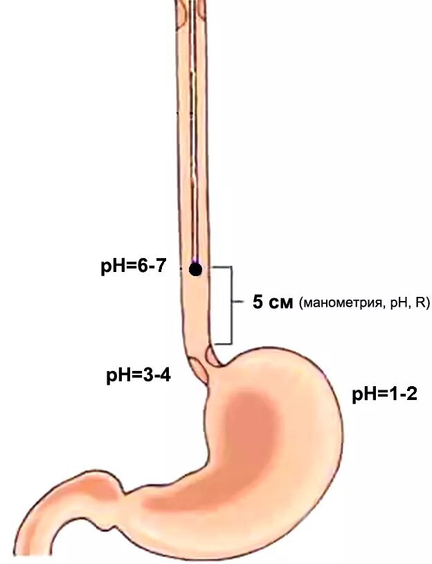 Кислотность пищевода. PH метрия пищевода. Суточная манометрия пищевода. PH метрия при ГЭРБ. Эзофагеальная манометрия.