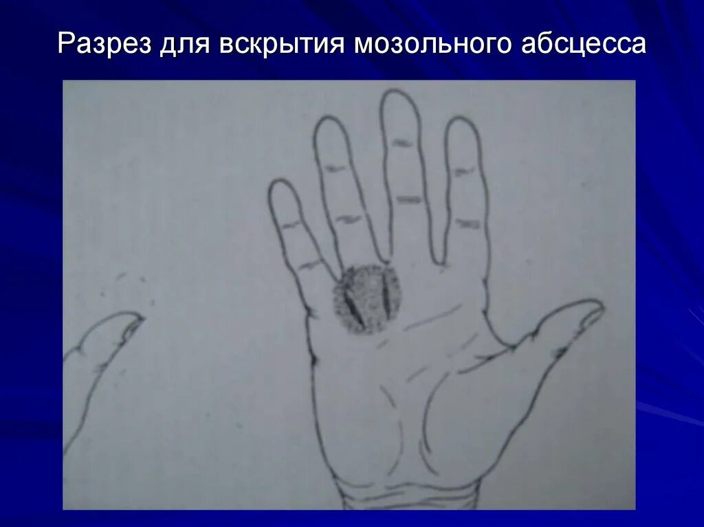 Разрезы при флегмонах ладони. Разрезы при тендовагинитах. Разрезы на кисти. Флегмона срединного пространства кисти. Разрезы при гнойных заболеваниях пальцев и кисти.