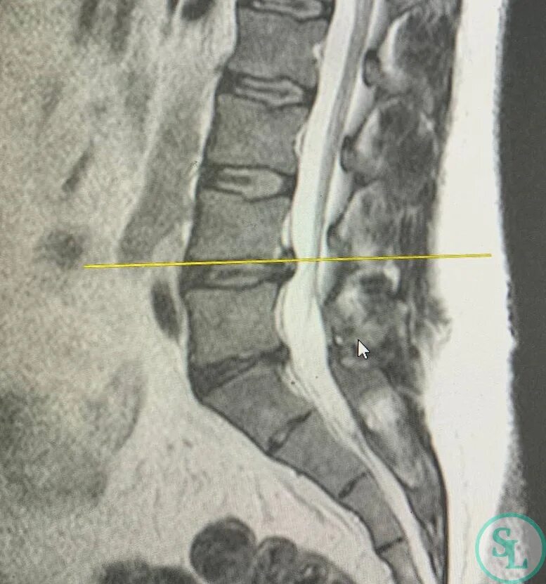 L4 l5 отдел позвоночника протрузия. Диск l4-l5. Грыжа диска l5-s1. Грыжа позвоночника l4 l5. Грыжа диска l4-l5.