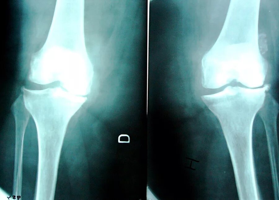 Остеоартрит коленного сустава рентген. Остеоартроз коленного сустава рентген. Артрозо-артрит коленного сустава рентген. Гонартроз коленного сустава рентген. Артроз коленного сустава название