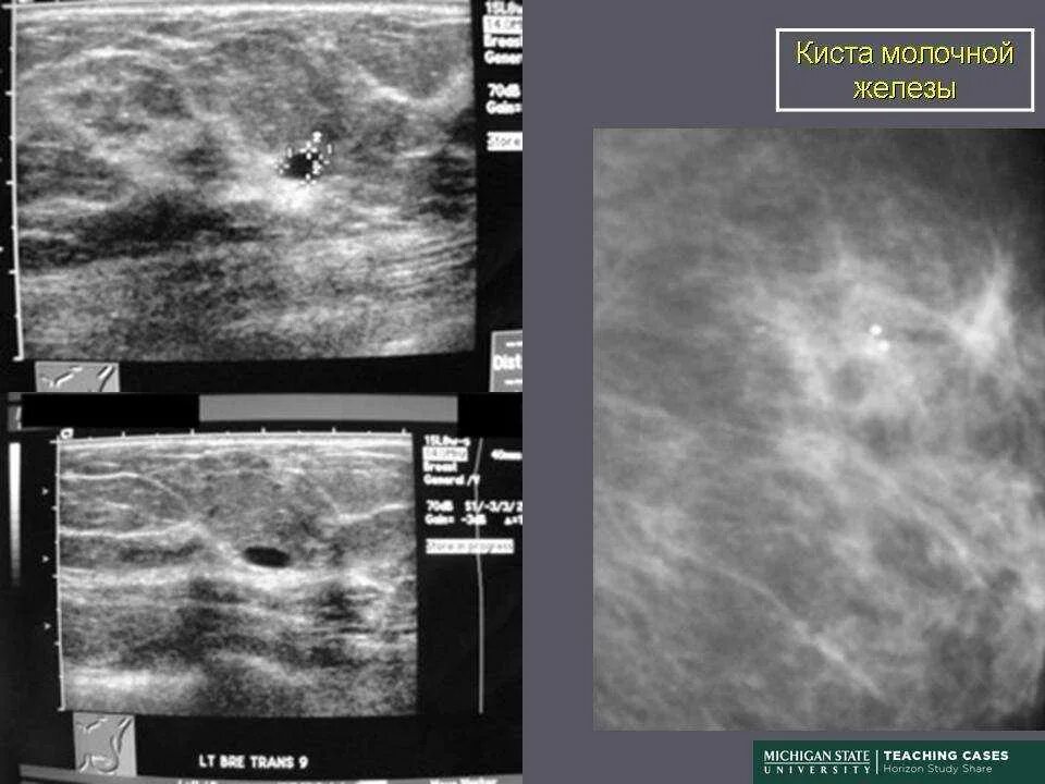 Железы кистозно расширены. Внутрипротоковая киста молочной железы. Протоковая киста молочной железы 12 мм. Ретенционные кисты молочной железы. Протоковая киста молочной железы эхограммы.