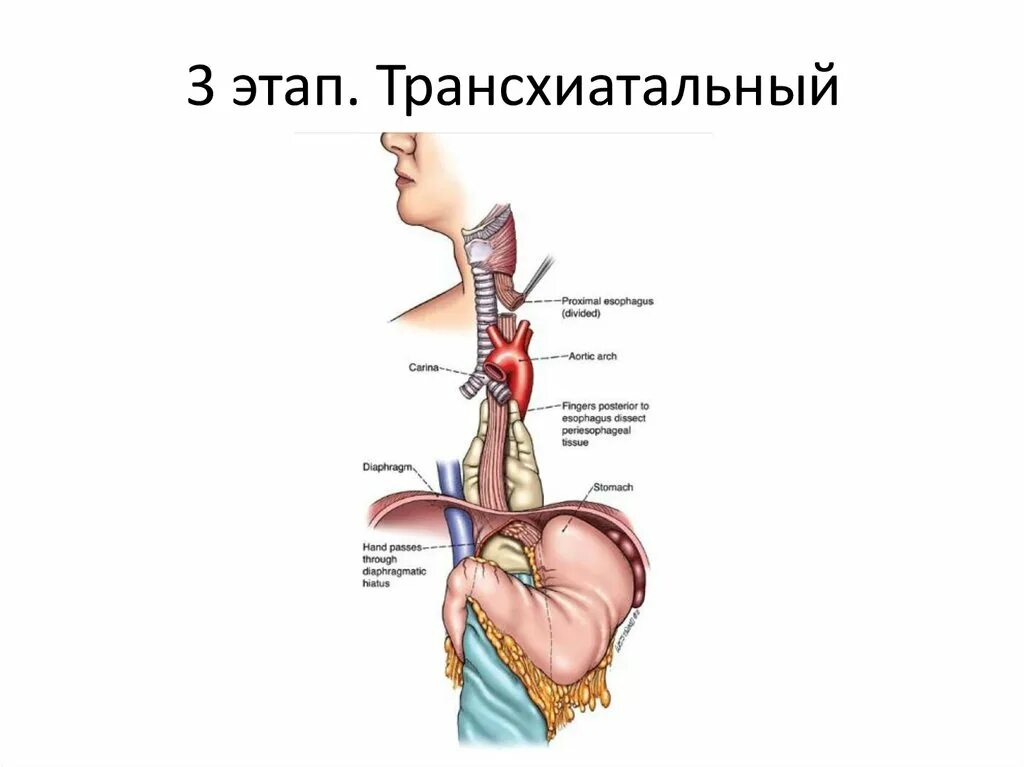 Пролапс желудка в пищевод. Трансхиатальный пролапс слизистой желудка в пищевод. Трансгиатальную экстирпацию пищевода. Трансхиатальная резекция пищевода. Гастроэзофагеальный пролапс желудка что это.