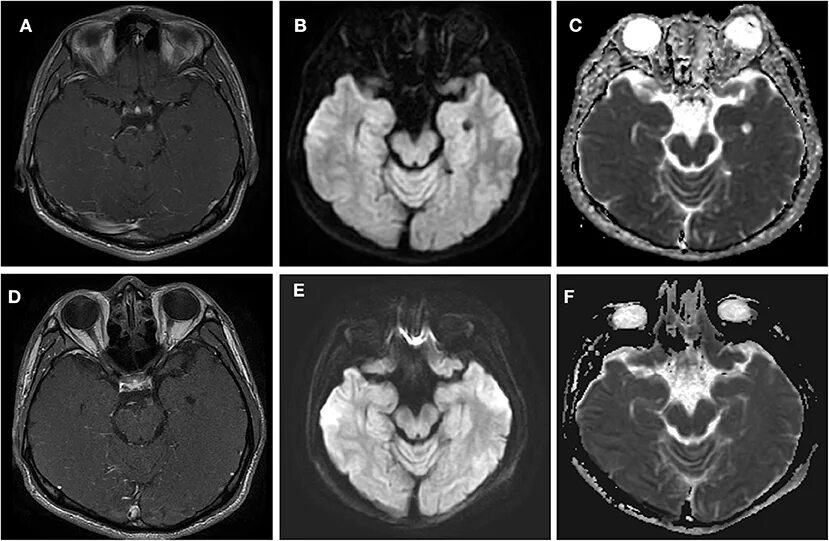 Лейкоэнцефалит