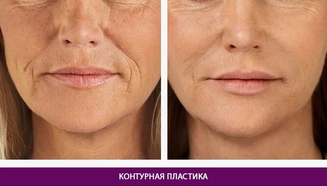 До и после коррекции формы и объема губ (фото)