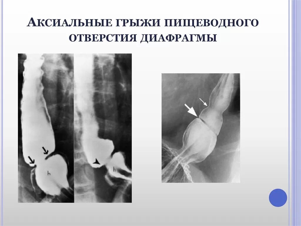 Грыжа под. Параэзофагеальная грыжа пищеводного отверстия диафрагмы рентген. аксиальная скользящая грыжа рентген. аксиальная фиксированная грыжа пищевода рентген. скользящая гпод рентген.