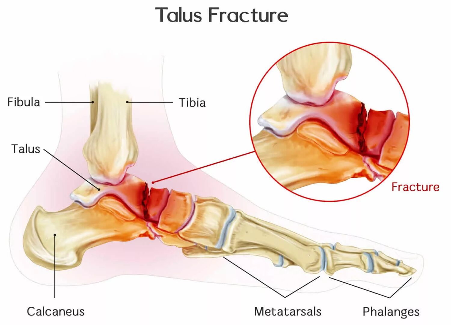 A fracture is a broken bone