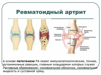 Артроз комплекс