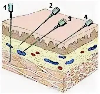 Внутрикожная глубина введения иглы