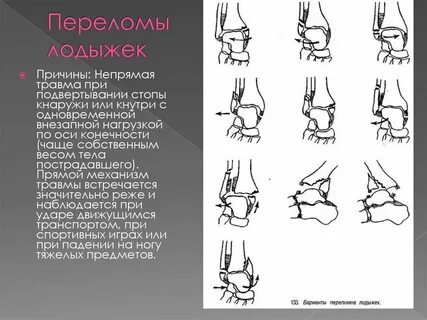 Сколько времени заживают переломы ноги