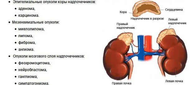 Болят ли надпочечники. Объемное образование левого надпочечника операция. Опухоль мозгового слоя надпочечников симптомы. Опухоли коры надпочечников классификация. Доброкачественная опухоль надпочечников название.