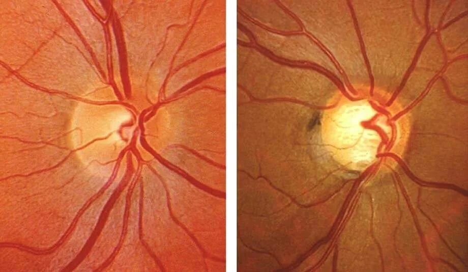 Нейропатия глаза. Зрительный нерв глаукома. Экскавация ДЗН. Экскавация зрительного нерва.