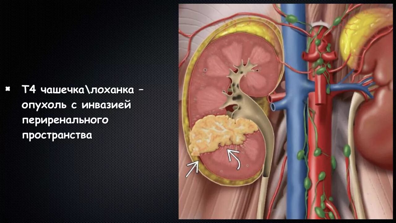 Метастазы в почках