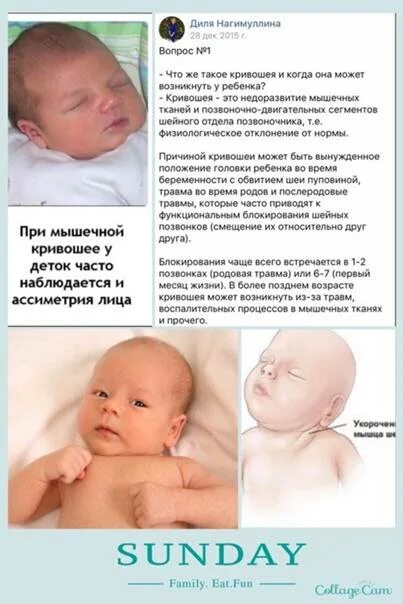 Для коррекции кривошеи важно понимать один ключевой момент Родитель сможет психо