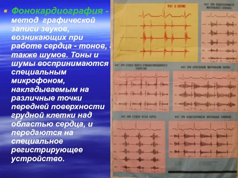 Звуки тона сердца. Графическая запись тонов сердца. Тоны сердца. Методы изучения тонов сердца. Графическая запись долгого звука.