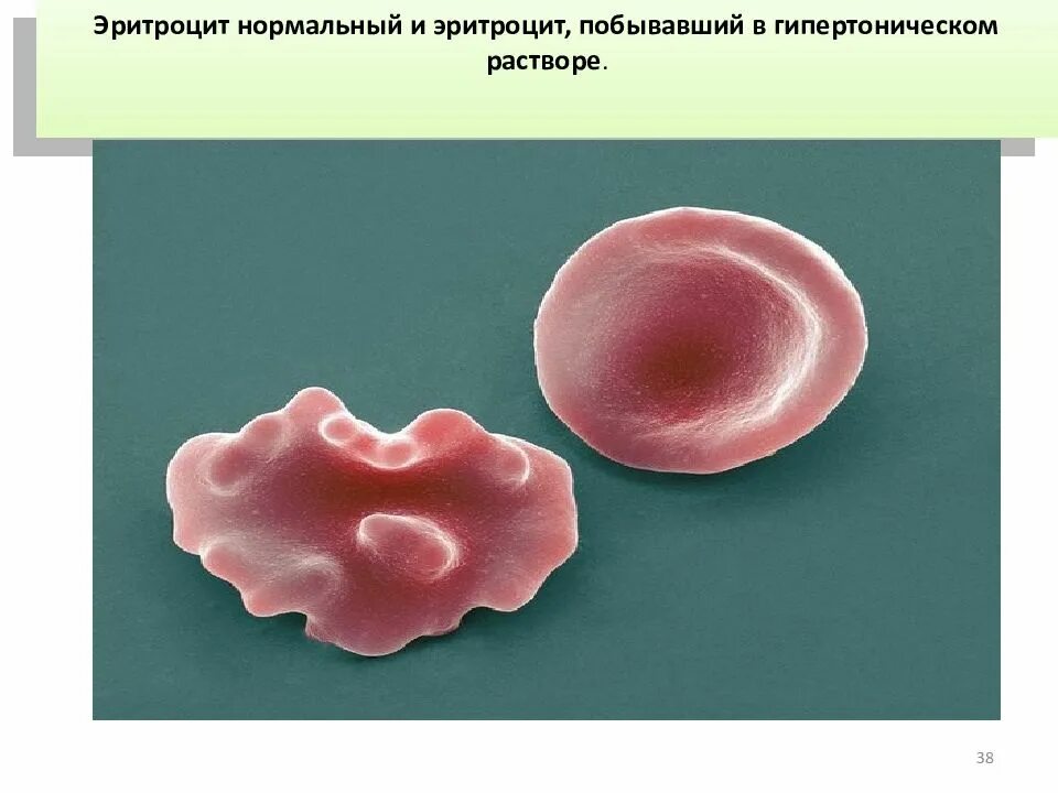 Эритроцит поместили в гипертонический раствор. Гипертонический раствор эритроциты. нормальные эритроциты. сморщивание эритроцитов в гипертоническом растворе. эритроциты в растворах.