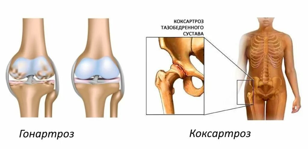 Артроз операция тазобедренного сустава