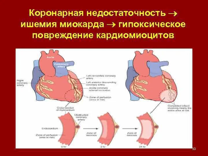 Острая сердечная коронарная недостаточность. Синдром острой коронарной недостаточности симптомы. Коронарогенная коронарная недостаточность. Проявление синдрома коронарной недостаточности. Синдром ишемического повреждения миокарда.