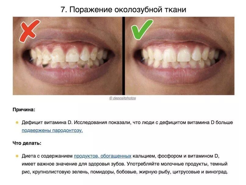 Зубы нехватки витаминов. Недостаток кальция в зубах. в зубах не хватает кальция. нехватка витаминов на губах.