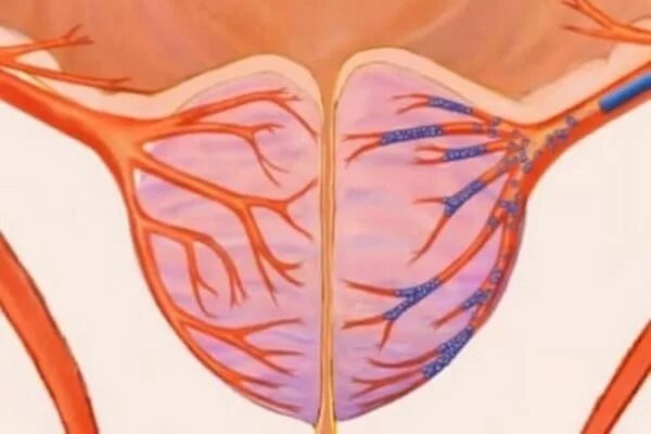 Артерии простаты. Эмболизация простатических артерий. Простатическая артерия. Эмболизация артерий простаты.