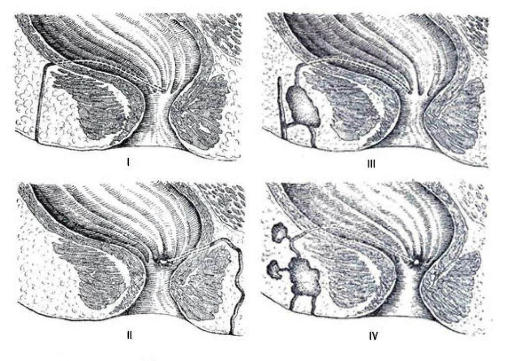 Трещины прохода. Неполный свищ парапроктит. Параректальный свищ (свищ прямой кишки). Чрессфинктерный парапроктит.. Иссечение парапроктита.