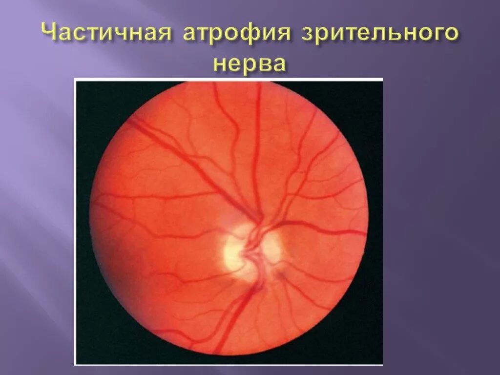 Нисходящая атрофия. Атрофия зрительного нерва Лебера генетика. Частичная атрофия зрительного нерва. Атрофия зрительного нерва глазное дно.