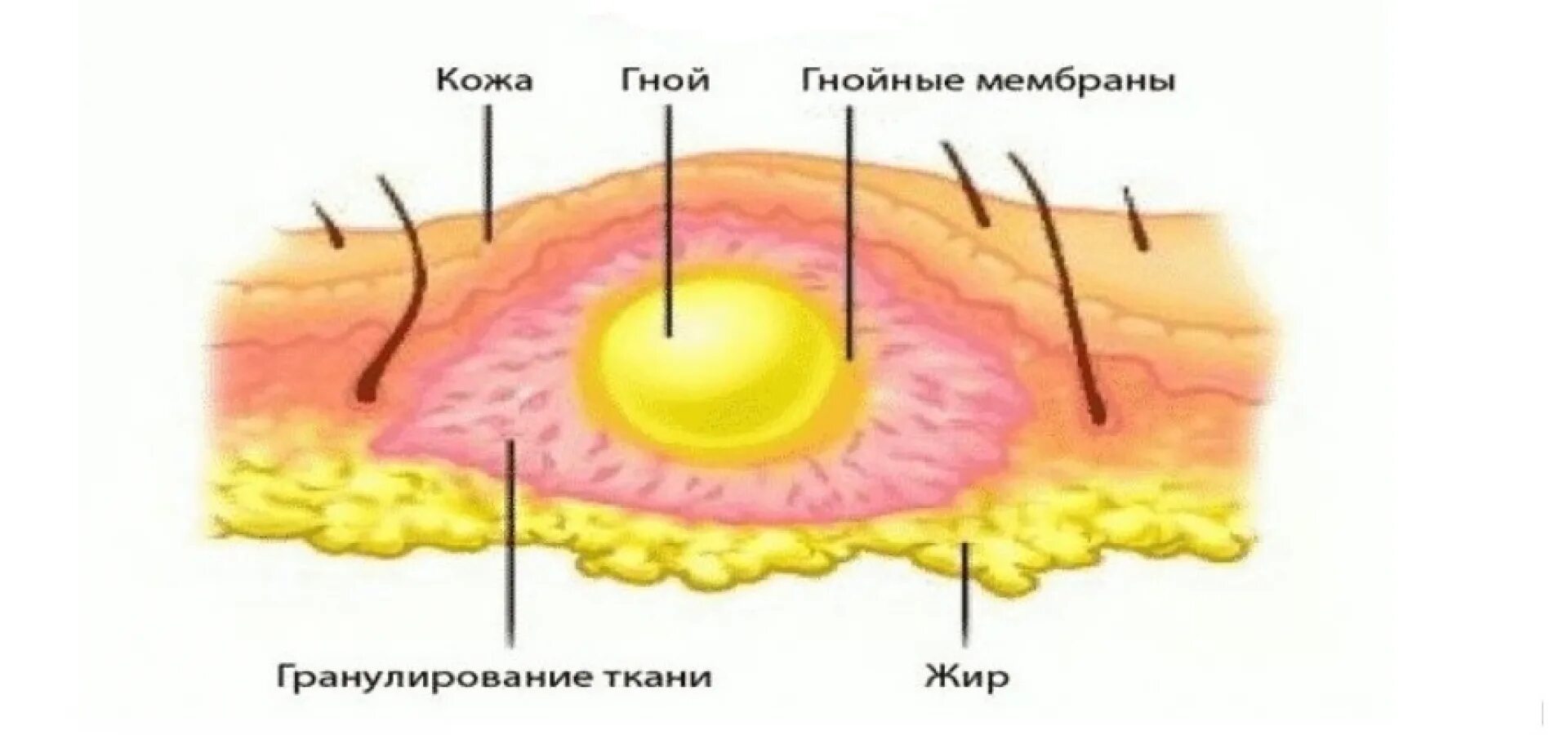 Как лечить абсцесс. Гнойное воспаление абсцесс. абсцесс гнойный воспалительный. гнойное расплавление тканей.