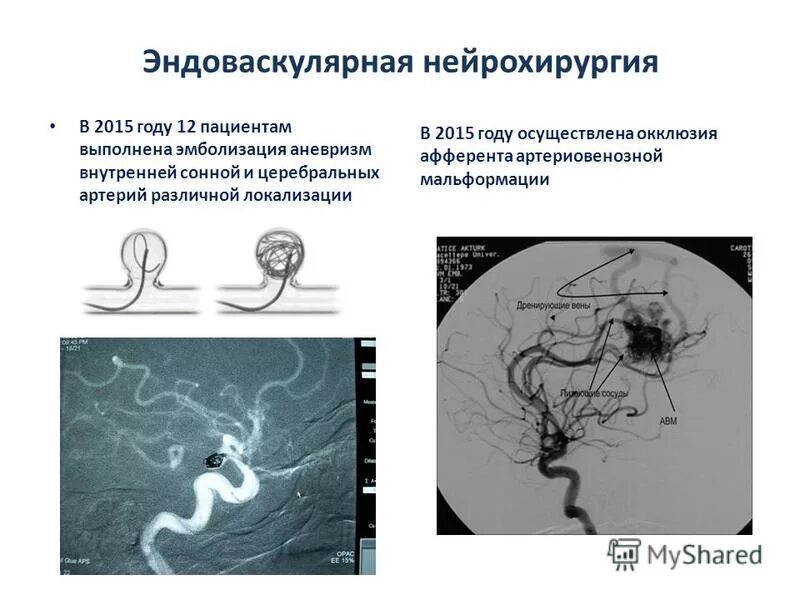 Аневризма головного мозга эндоваскулярным