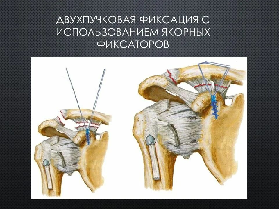 Разрыв акромиально ключичного сочленения операция. Разрыв акромиально-ключичного сочленения плечевого сустава операция. разрыв связок акромиально-ключичного сочленения. повреждение связок акромиально ключичного сустава. вывих акромиального конца ключицы операция.