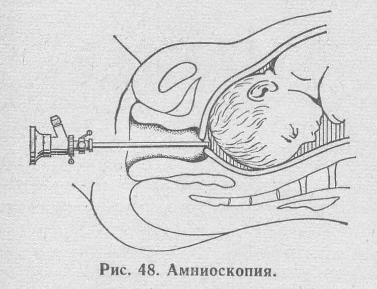 Амниоскопия околоплодных вод. Пункция околоплодных вод. Амниоскопия и амниоцентез. Цервикальная амниоскопия. Через сколько начинаются роды после прокола пузыря