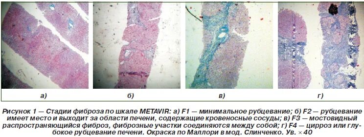 Как лечить фиброзные изменения