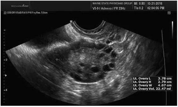 Мультифолликулярные яичники на УЗИ. Мелкофолликулярные яичники на УЗИ. УЗИ при мультифолликулярных яичниках. Мультифолликулярная структура яичников по УЗИ. Мфя в гинекологии что