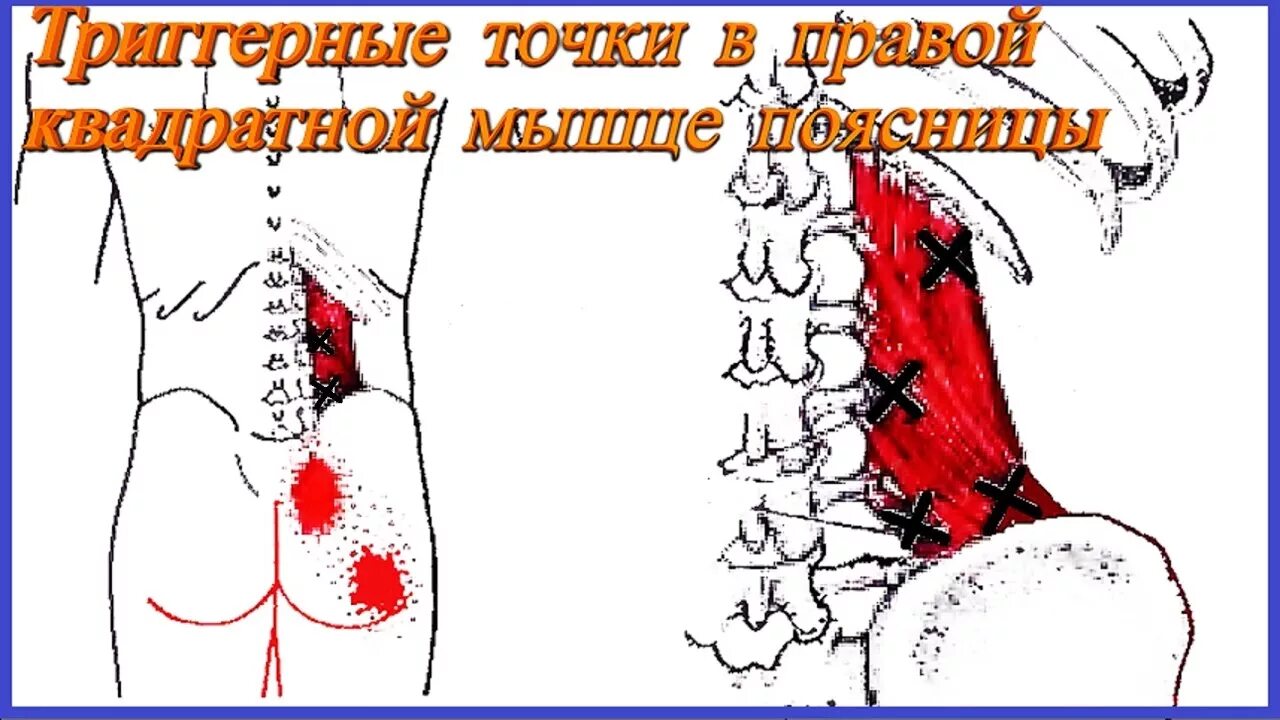 Триггерные точки поясницы. Квадратная мышца поясницы триггерные точки. Миофасциальный синдром триггеры. Миофасциальный синдром пояснично-крестцового. Миофасциальный синдром квадратной мышцы поясницы.