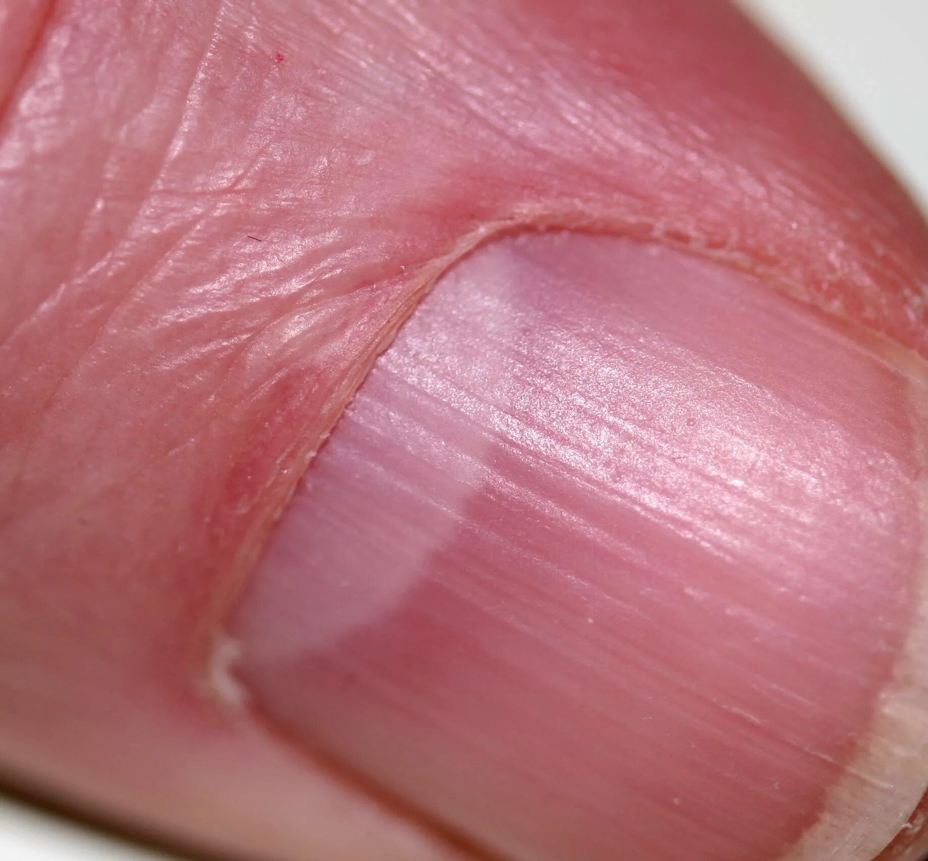 Полоски на ногтях причины вертикальные у женщин. Онихорексис трахионихия. Онихорексис онихомикоз. Псориатическая ониходистрофия. Поперечные борозды бо-Рейли.