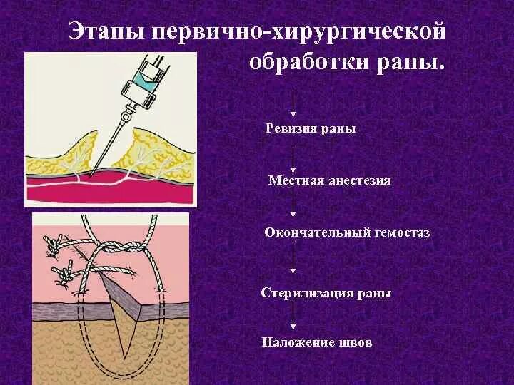 Промывание гнойной раны. Первичная хирургическая обработка раны (Пхо). Методика Пхо раны бедра. Первичная хирургическая обработка гнойной раны.