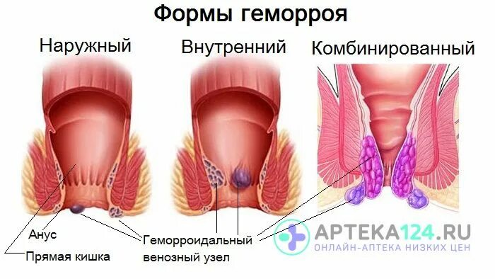 Кровотечение при геморрое - причины и лечение