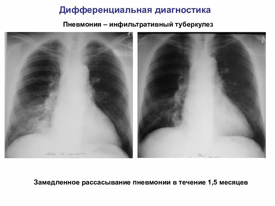 Дифференциальный диагноз инфильтративный туберкулез. Инфильтративный туберкулез диагноз. Дифференциальная диагностика инфильтративного туберкулеза. Пневмония рентгенограмма дифференциальный диагноз.